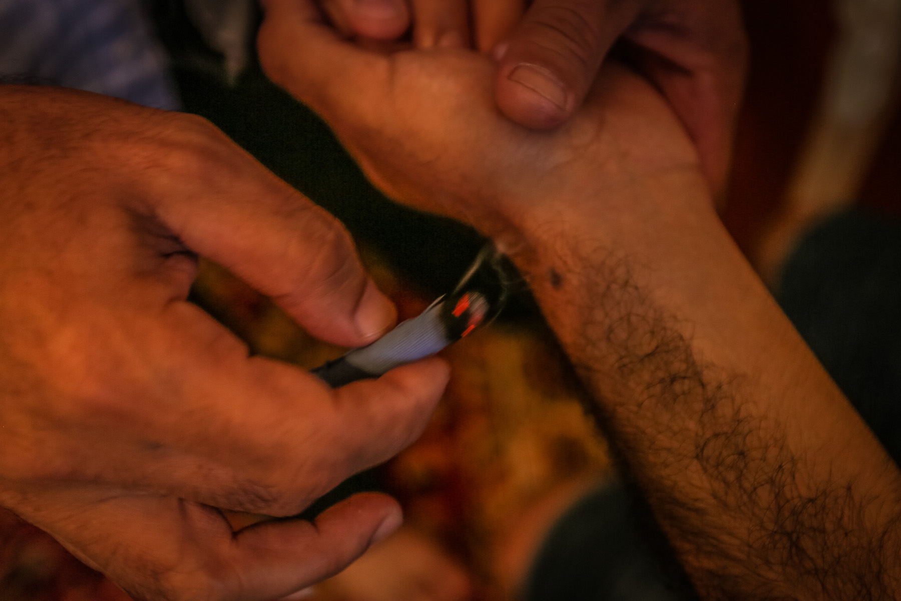 İnsandan qorxunu çıxartmaq üçün kətan parçanı yandıraraq bədənin müəyyən nöqtələrinə vururlar